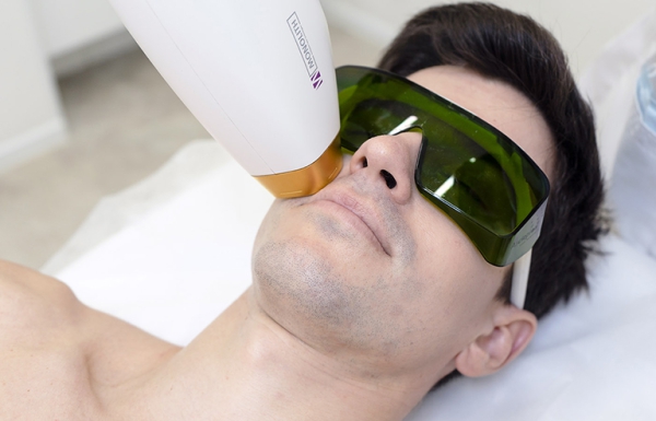 Лазерная эпиляция для мужчин